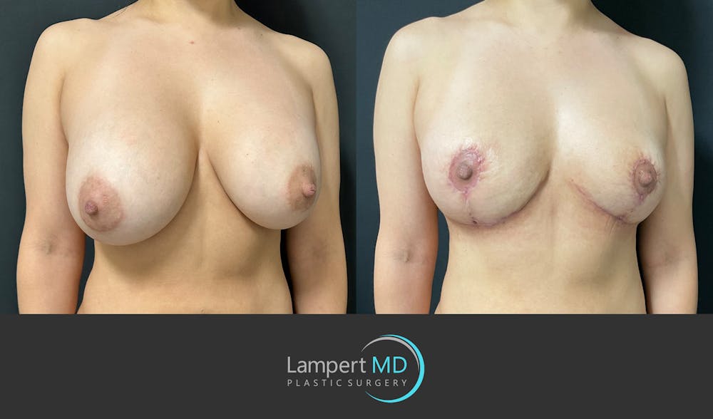 Breast Explant Before & After Gallery - Patient 148370137 - Image 2