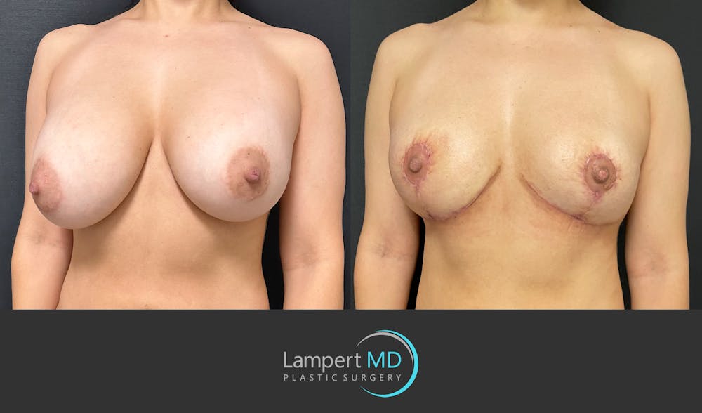 Breast Explant Before & After Gallery - Patient 148370137 - Image 3