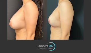 Breast Explant Before & After Gallery - Patient 148370137 - Image 4