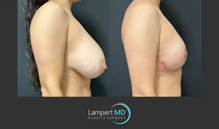 Breast Explant Before & After Gallery - Patient 148370137 - Image 5