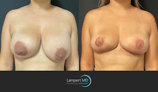 Breast Explant Before & After Gallery - Patient 148520622 - Image 1