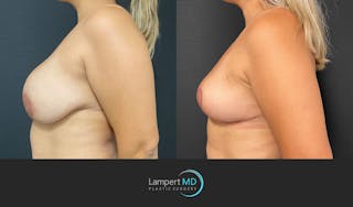 Breast Explant Before & After Gallery - Patient 148520622 - Image 2