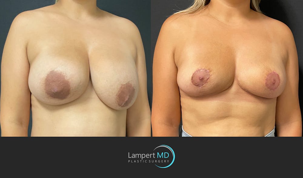 Breast Explant Before & After Gallery - Patient 148520622 - Image 3