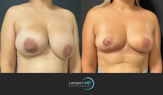 Breast Explant Before & After Gallery - Patient 148520622 - Image 3