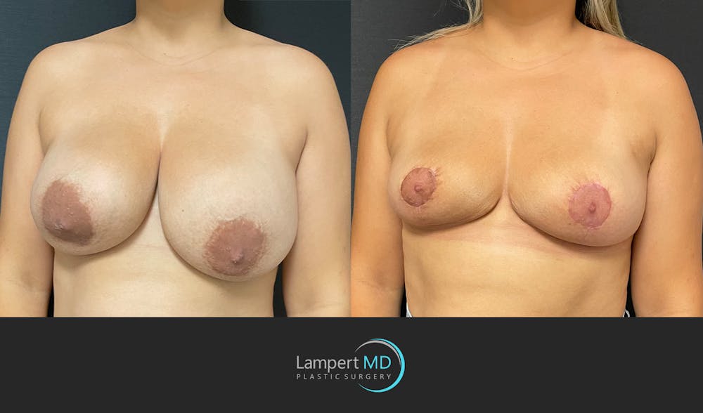 Breast Explant Before & After Gallery - Patient 148520622 - Image 4