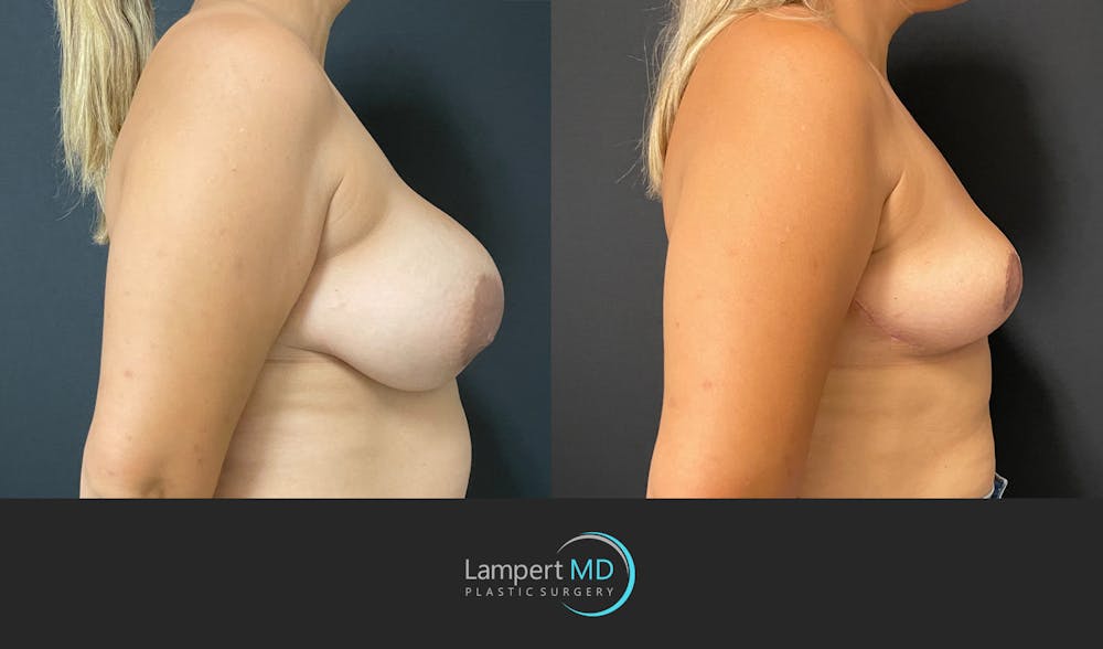 Breast Explant Before & After Gallery - Patient 148520622 - Image 5