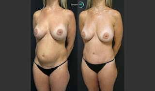 Tummy Tuck Before & After Gallery - Patient 148520453 - Image 2