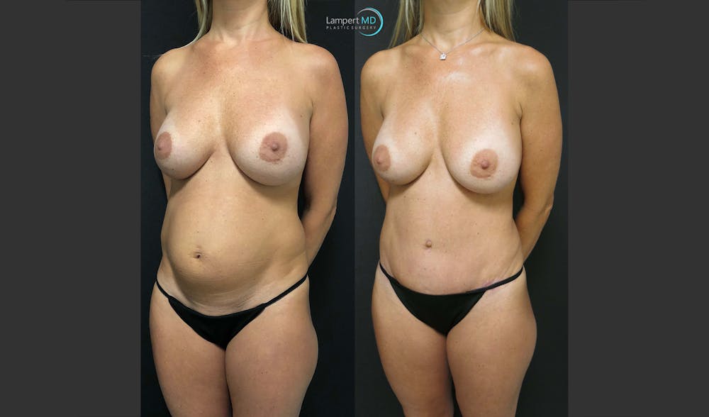 Tummy Tuck Before & After Gallery - Patient 148520453 - Image 2