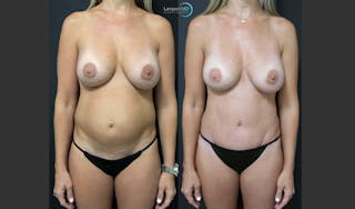 Tummy Tuck Before & After Gallery - Patient 148520453 - Image 1