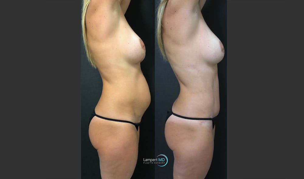 Tummy Tuck Before & After Gallery - Patient 148520453 - Image 3