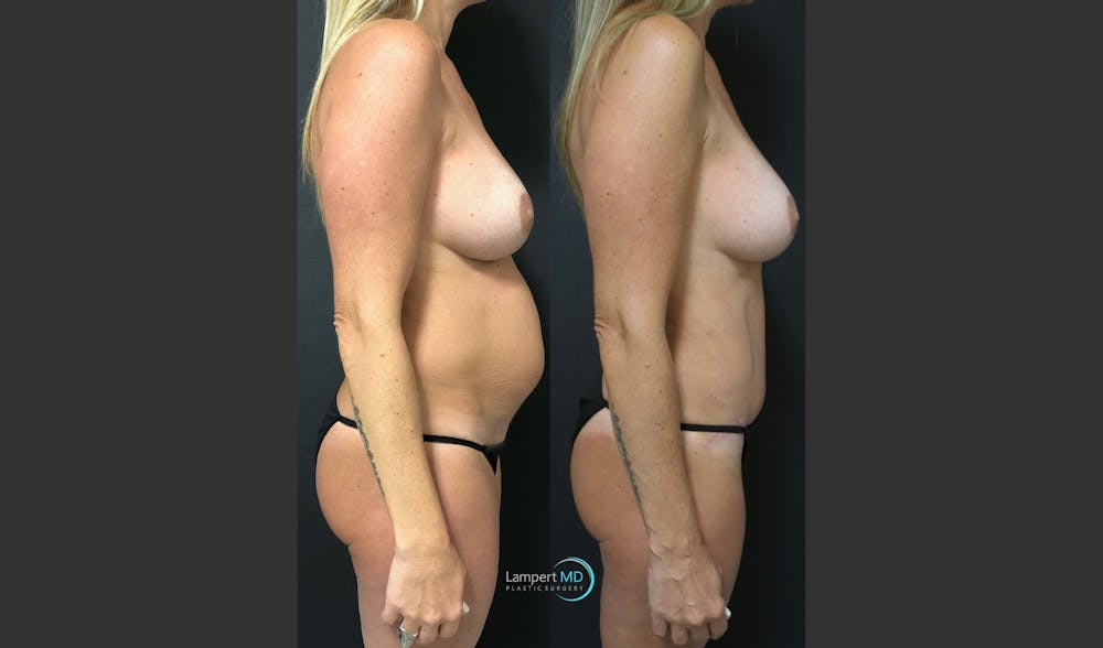 Tummy Tuck Before & After Gallery - Patient 148520453 - Image 4