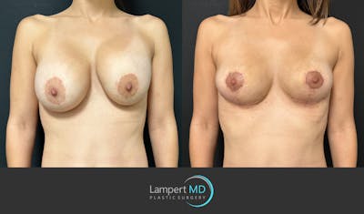 Breast Explant Before & After Gallery - Patient 148520589 - Image 1