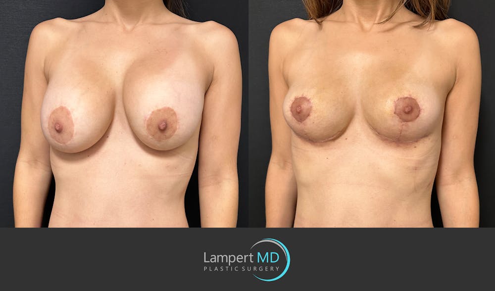 Breast Explant Before & After Gallery - Patient 148520589 - Image 2