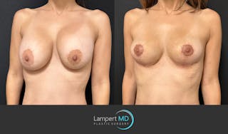 Breast Explant Before & After Gallery - Patient 148520589 - Image 2