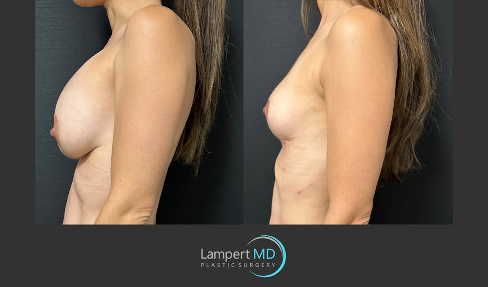 Breast Explant Before & After Gallery - Patient 148520589 - Image 3