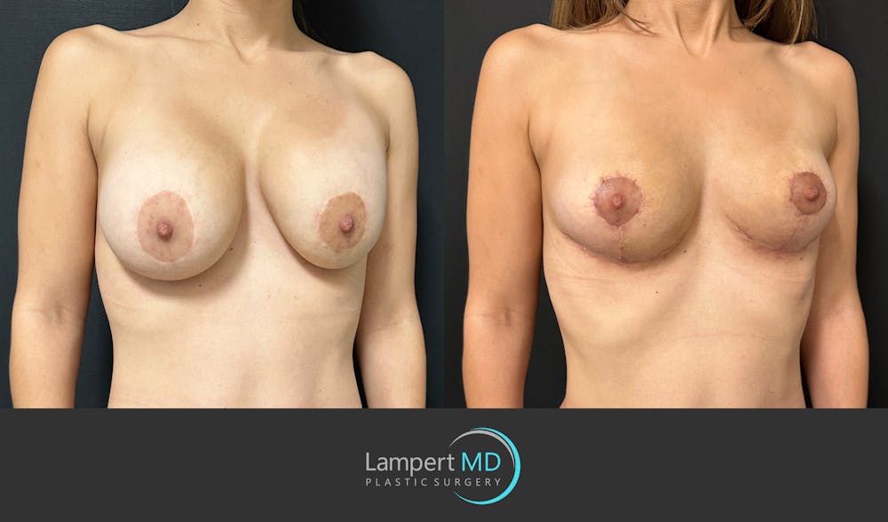 Breast Explant Before & After Gallery - Patient 148520589 - Image 4