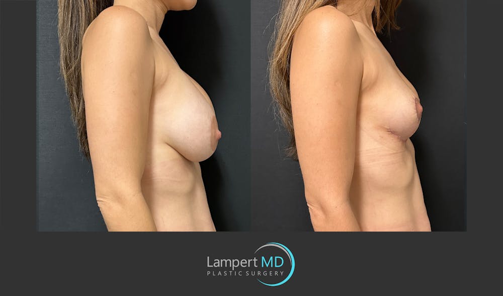 Breast Explant Before & After Gallery - Patient 148520589 - Image 5