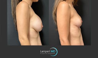 Breast Explant Before & After Gallery - Patient 148520589 - Image 5