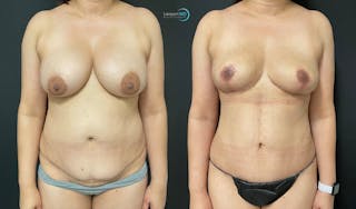 Breast Explant Before & After Gallery - Patient 159008904 - Image 1