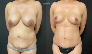 Breast Explant Before & After Gallery - Patient 159008904 - Image 2