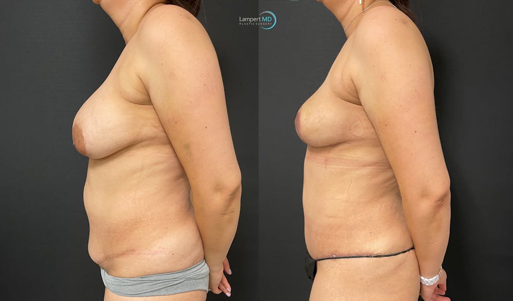 Breast Explant Before & After Gallery - Patient 159008904 - Image 3