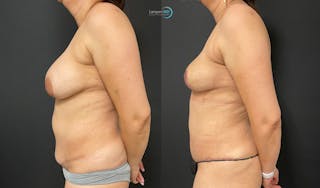 Breast Explant Before & After Gallery - Patient 159008904 - Image 3