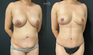 Breast Explant Before & After Gallery - Patient 159008904 - Image 4