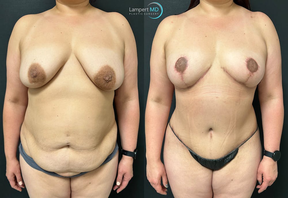 Breast Explant Before & After Gallery - Patient 148520623 - Image 1