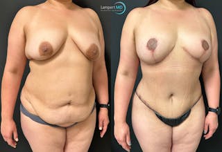 Breast Explant Before & After Gallery - Patient 148520623 - Image 2