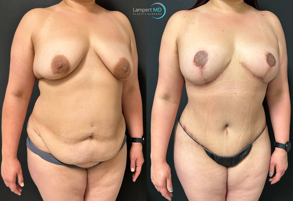 Breast Explant Before & After Gallery - Patient 148520623 - Image 2