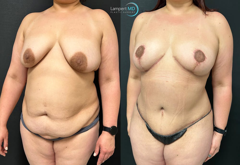 Breast Explant Before & After Gallery - Patient 148520623 - Image 3