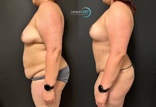 Breast Explant Before & After Gallery - Patient 148520623 - Image 5