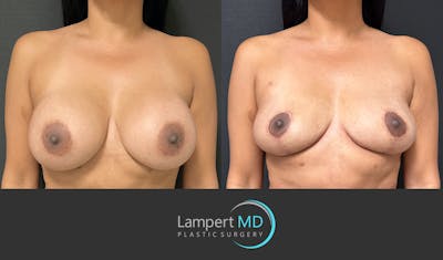 Breast Explant Before & After Gallery - Patient 148733953 - Image 1