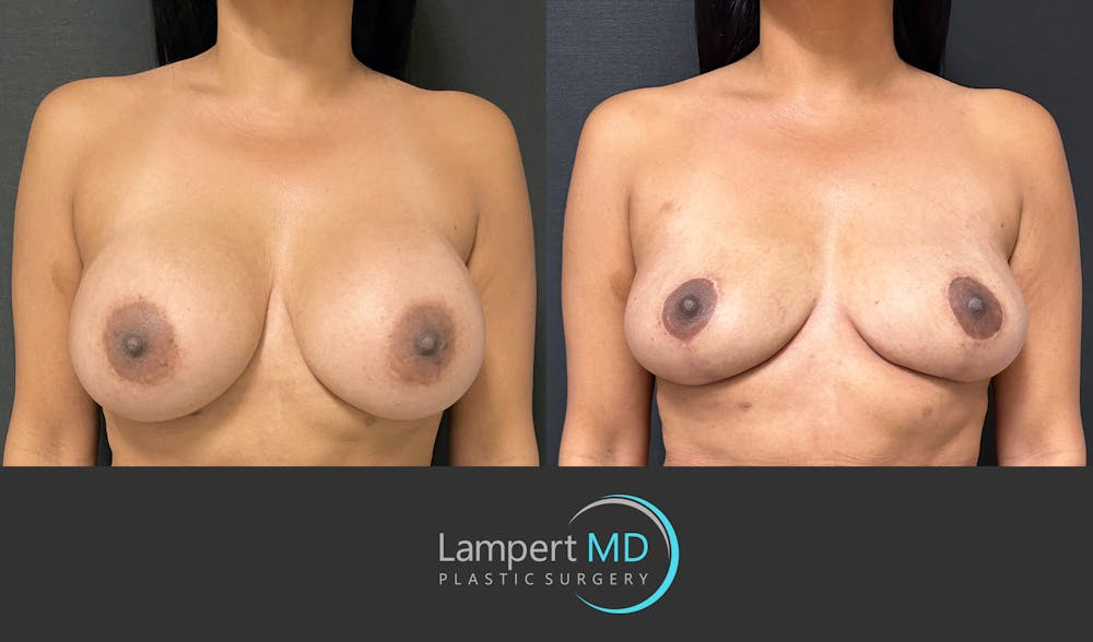 Breast Explant Before & After Gallery - Patient 148733953 - Image 1