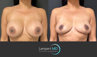 Breast Explant Before & After Gallery - Patient 148733953 - Image 1