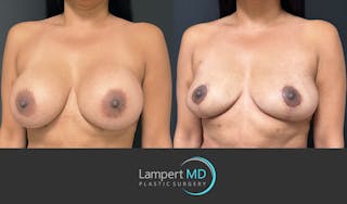 Breast Explant Before & After Gallery - Patient 148733953 - Image 2
