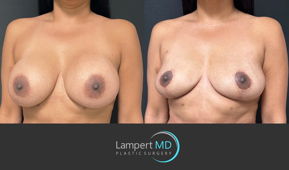 Breast Explant Before & After Gallery - Patient 148733953 - Image 2