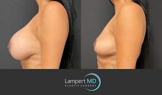 Breast Explant Before & After Gallery - Patient 148733953 - Image 3