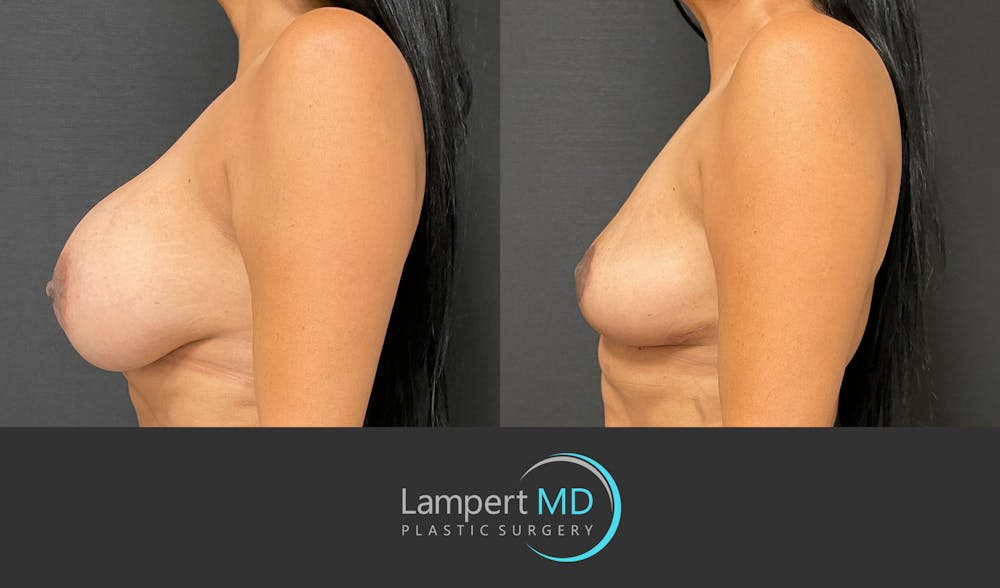 Breast Explant Before & After Gallery - Patient 148733953 - Image 3