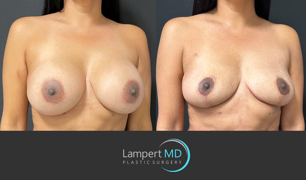 Breast Explant Before & After Gallery - Patient 148733953 - Image 4