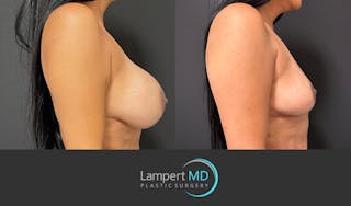 Breast Explant Before & After Gallery - Patient 148733953 - Image 5