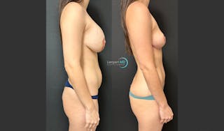 Breast Explant Before & After Gallery - Patient 148733968 - Image 2