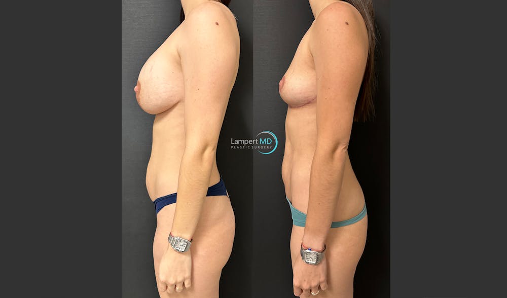 Breast Explant Before & After Gallery - Patient 148733968 - Image 4