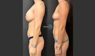 Breast Explant Before & After Gallery - Patient 148733968 - Image 4