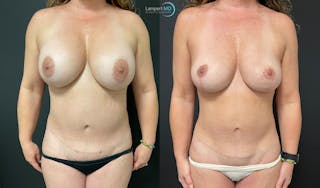 Breast Explant Before & After Gallery - Patient 148734396 - Image 1