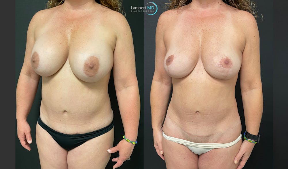 Breast Explant Before & After Gallery - Patient 148734396 - Image 2