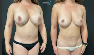 Breast Explant Before & After Gallery - Patient 148734396 - Image 3