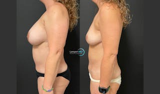 Breast Explant Before & After Gallery - Patient 148734396 - Image 4