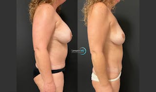 Breast Explant Before & After Gallery - Patient 148734396 - Image 5