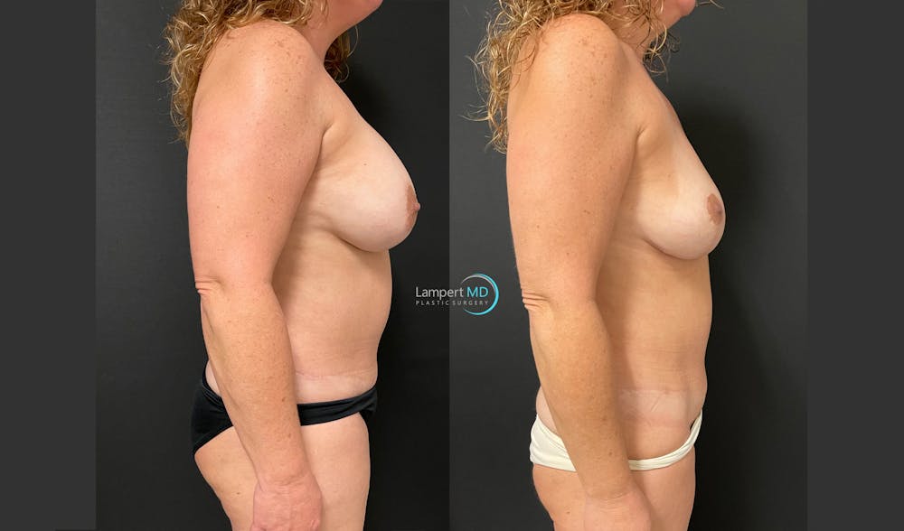 Breast Explant Before & After Gallery - Patient 148734396 - Image 5